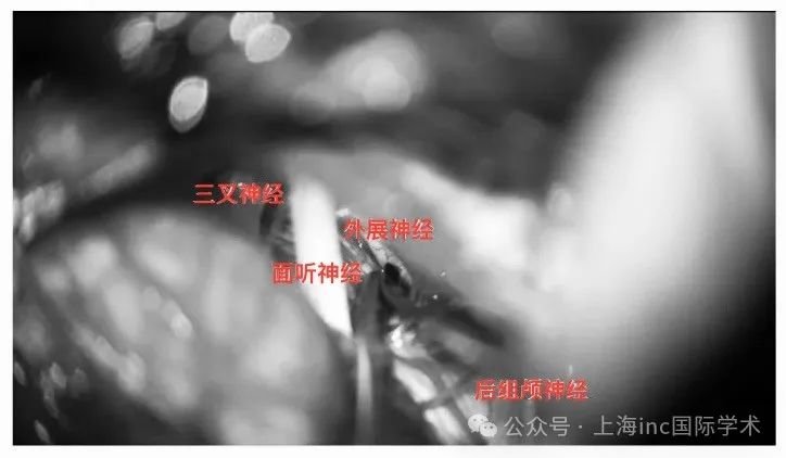 三叉神經(jīng)、面聽神經(jīng)、外展神經(jīng)、后組神經(jīng)保護(hù)完好