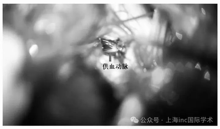 斷除畸形血管團(tuán)供血動脈