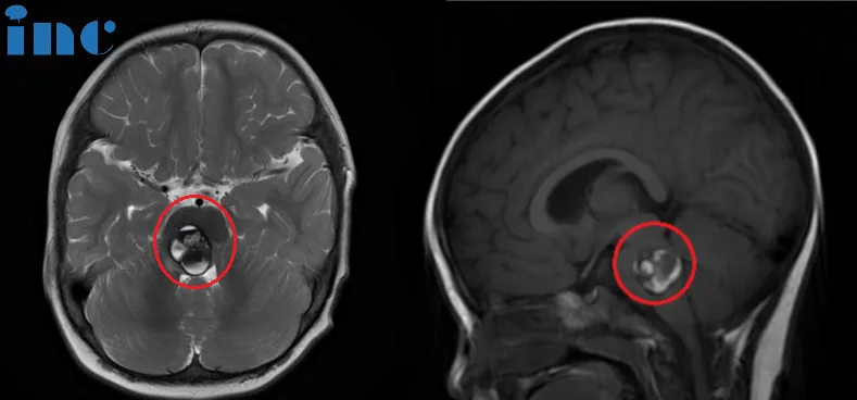 術前：腦橋占位。雙眼斜視、畏光，面癱，頻發(fā)不自主扭頭動作，走路稍有不穩(wěn)。頭顱MR (紅色區(qū)域) 顯示: 腦橋血腫，可見16 x 22 x 21mm腫塊，第四腦室受壓變窄。