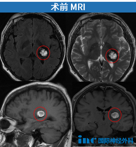 術(shù)前mri