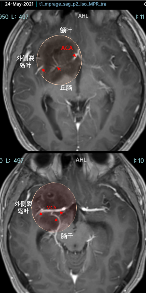 腫瘤血管豐富包裹大腦前動脈、大腦中動脈及其分支等