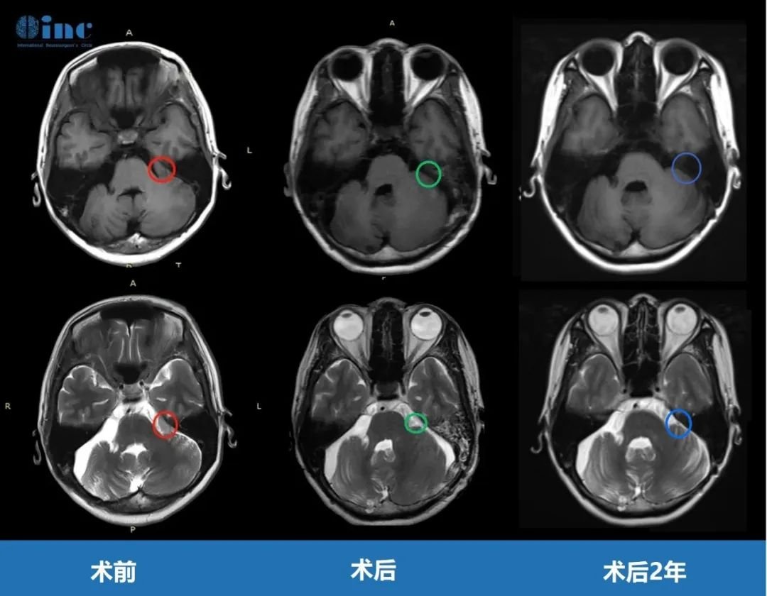 CPA區(qū)腦膜瘤手術(shù)治療總結(jié)