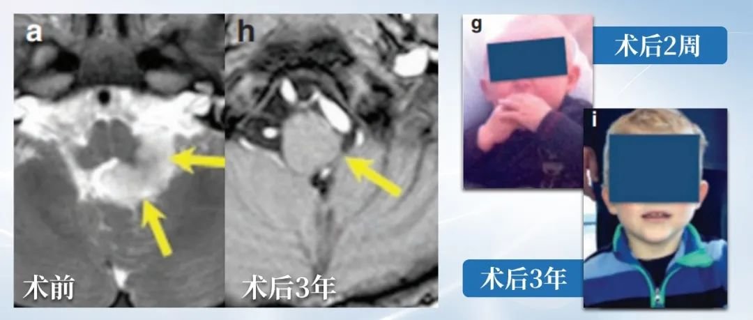 經(jīng)過一場(chǎng)全切手術(shù)，小Nick得以”絕處逢生“，術(shù)后3年復(fù)查核磁未見腫瘤復(fù)發(fā)