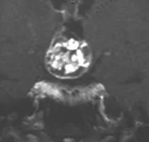 Daniel的腦部核磁共振（MRI）顯示鞍區(qū)存在顱咽管瘤，已從向上生長侵入第三腦室。在內(nèi)分泌檢查中，他還被發(fā)現(xiàn)垂體功能部分不足。