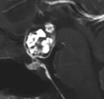 Daniel的腦部核磁共振（MRI）顯示鞍區(qū)存在顱咽管瘤，已從向上生長侵入第三腦室。在內(nèi)分泌檢查中，他還被發(fā)現(xiàn)垂體功能部分不足。