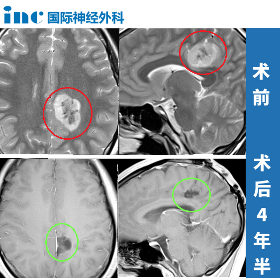 從“術(shù)后可能偏癱”到“術(shù)后第二天行走”，從“天塌了”到“重獲新生”