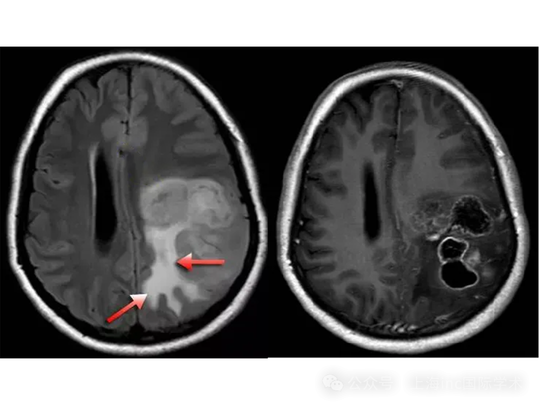FLAIR序列腫瘤為稍高信號，腫瘤周圍白質(zhì)內(nèi)見不規(guī)則形高信號水腫，勾勒出局部腦白質(zhì)形態(tài)，水腫呈指套樣伸向白質(zhì)。