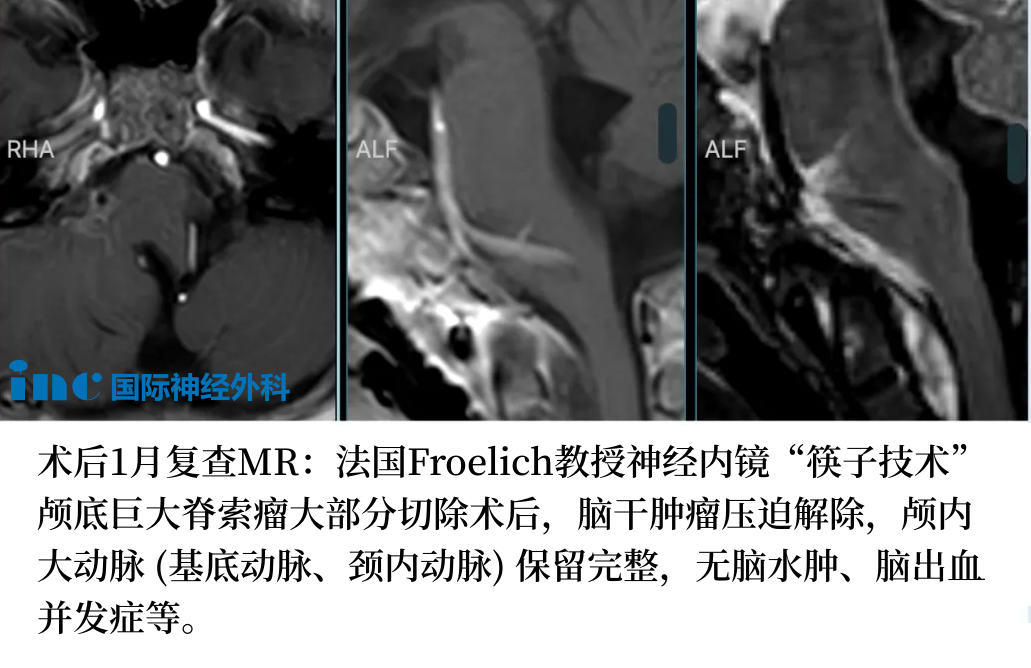 術(shù)后兩天，林林順利轉(zhuǎn)出ICU，無新增并發(fā)癥。術(shù)后10天，林林順利出院。