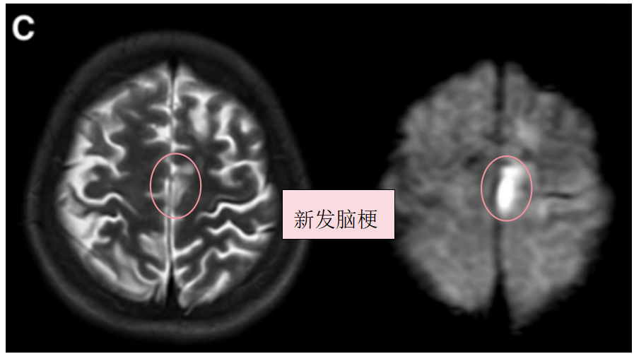 術(shù)前T2、DWI序列顯示左額葉新發(fā)展的腦梗死。
