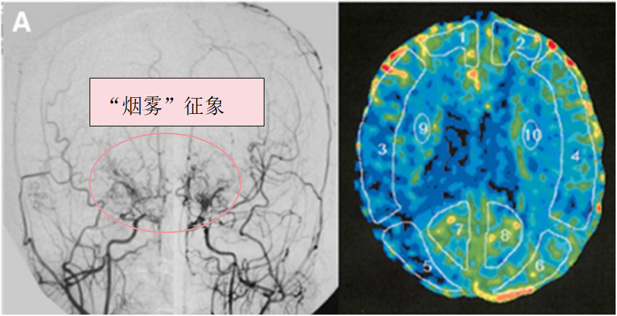當(dāng)煙霧病合并甲亢，先治哪邊？國際神外專家破解治療困局