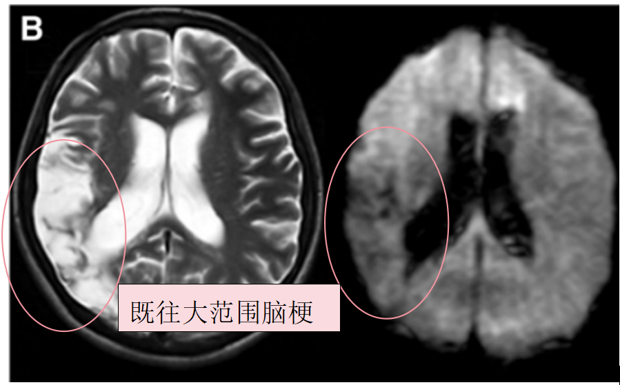 術(shù)前T2、DWI序列顯示入院前1個(gè)月顯示，既往右側(cè)額頂葉腦梗死