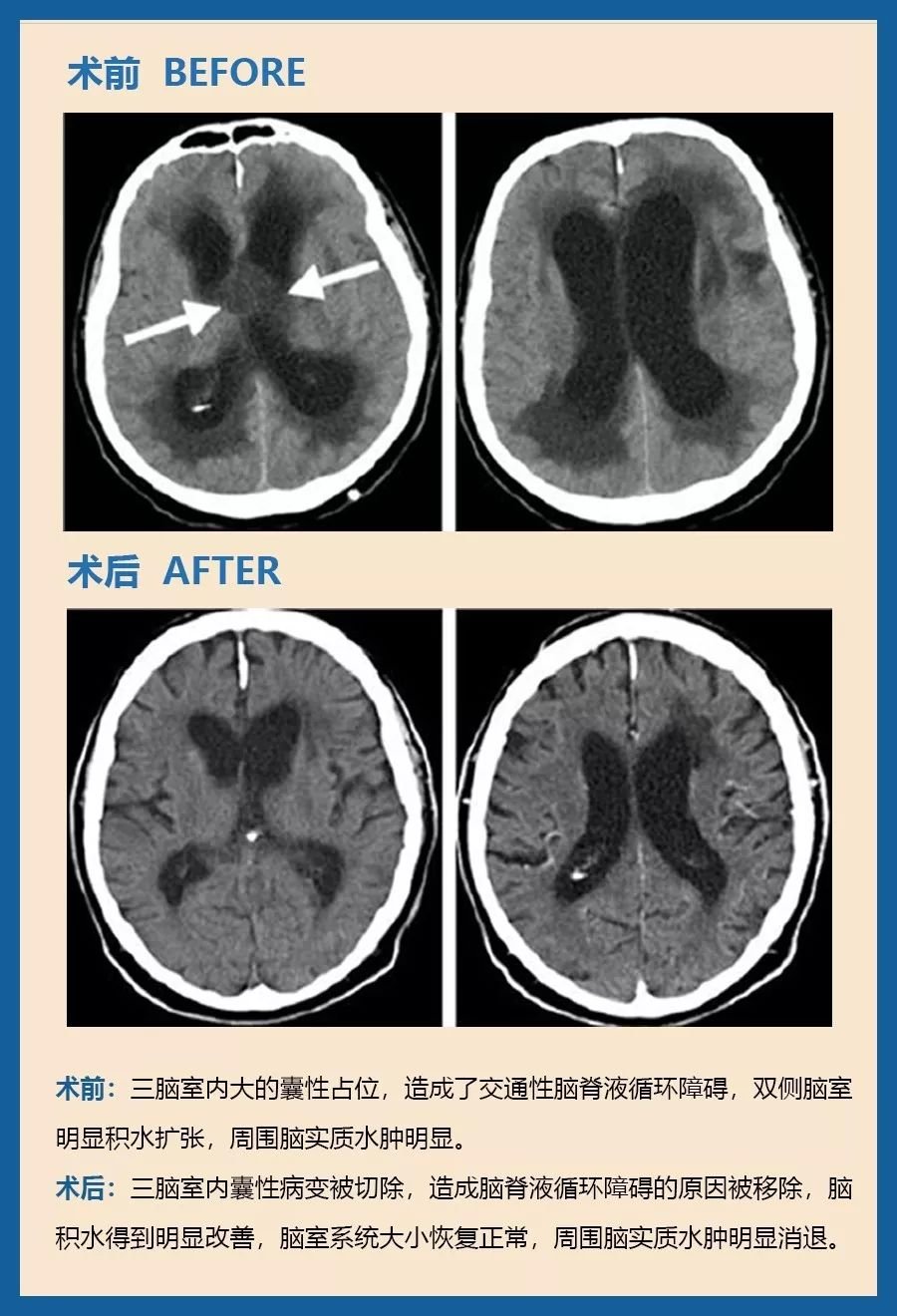 72歲，顱咽管瘤，緩慢進(jìn)行性精神衰退