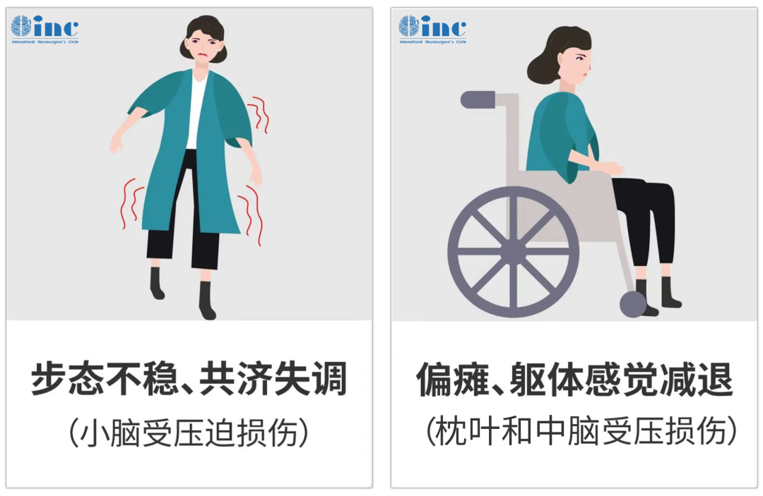 被保留下來(lái)的腦膜瘤隨著時(shí)間流逝，會(huì)慢慢長(zhǎng)大，向下生長(zhǎng)壓迫小腦，會(huì)走路不穩(wěn)、共濟(jì)失調(diào)。