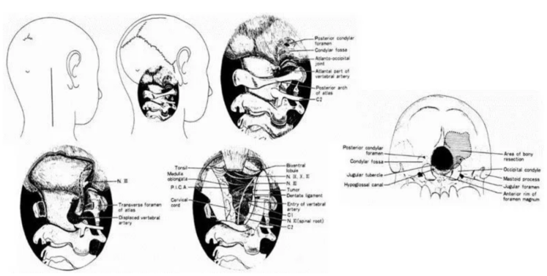 巴特朗菲教授和其導(dǎo)師Seeger(1991)提出的“dorsolateral , suboccipital , transcondylar approach”入路