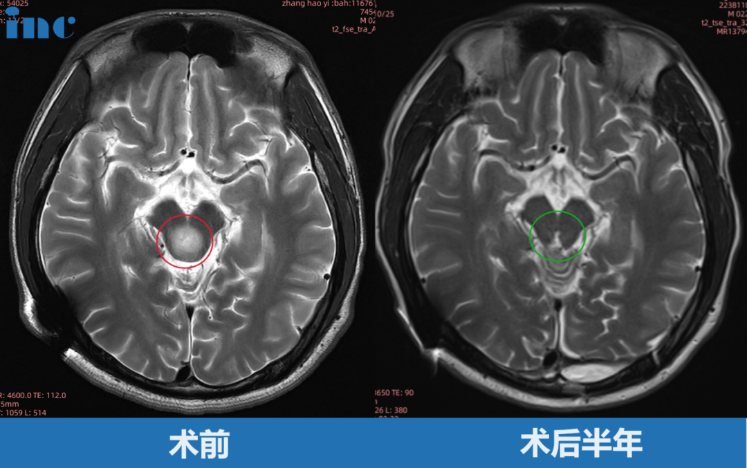 巴教授術(shù)后半年隨訪中，影像顯示腫瘤沒有殘留，更沒有復(fù)發(fā)。