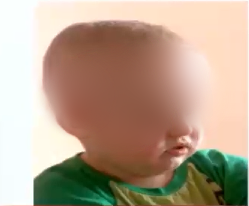 ＂這孩子沒法手術＂→視路膠質(zhì)瘤全切！2歲男孩小腦袋里的大戰(zhàn)役