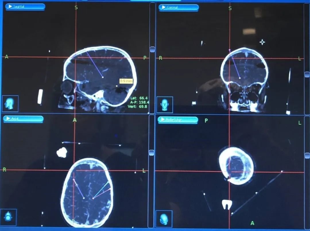 (在SickKids，Andi的神經(jīng)外科醫(yī)生小心地將電極植入她的大腦中)