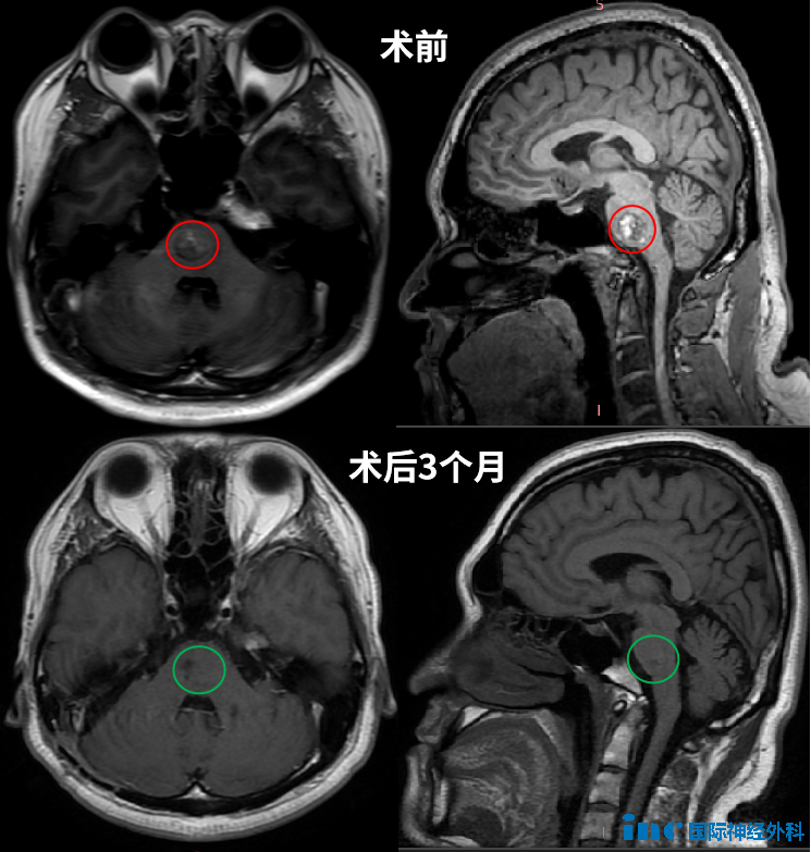 術(shù)前術(shù)后MRI