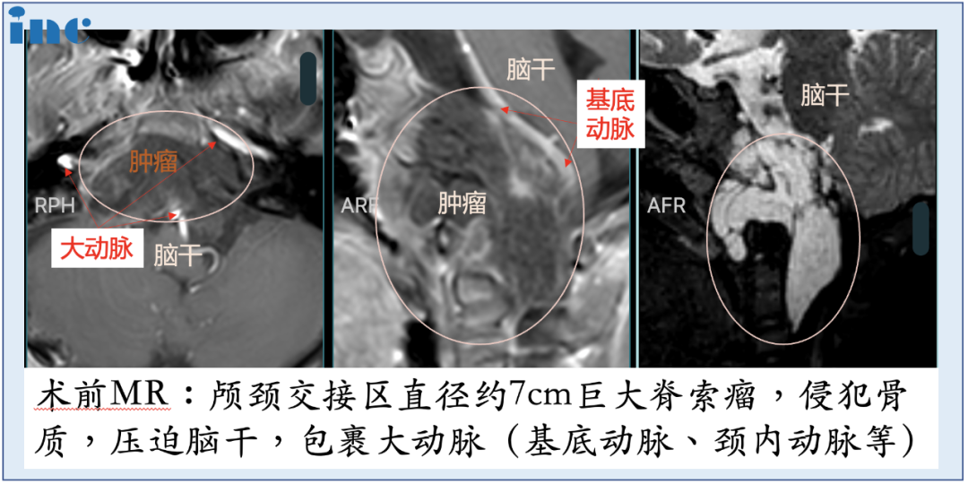 腫瘤位置特殊，體積巨大，明顯壓迫腦干，林林在國(guó)內(nèi)接受了第一次手術(shù)，部分減少腫瘤的體積。