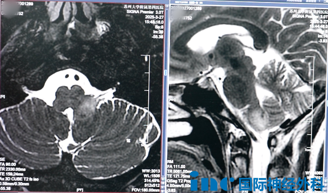 湯女士的腫瘤長在腦干延髓上，其內(nèi)含有心跳、呼吸、消化等基本生命中樞。解剖關(guān)系復(fù)雜、位置深、遍布重要神經(jīng)血管等，手術(shù)難度很高