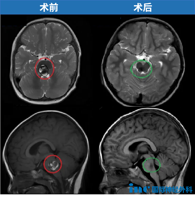 2歲，聰聰，腦干-腦橋海綿狀血管瘤，2019年巴教授中國示范手術(shù)，順利全切腫瘤，目前已經(jīng)在上小學(xué)。