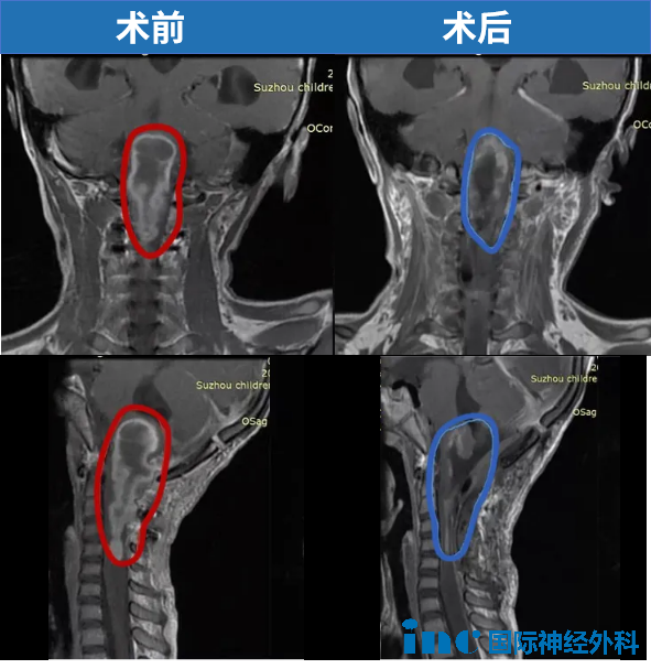 6歲，琦琦，腦干延髓，一直延伸至頸5節(jié)段脊髓，巴教授中國示范手術(shù)，腫瘤幾近全切。術(shù)后3年，琦琦可以像正常孩子一樣玩耍。