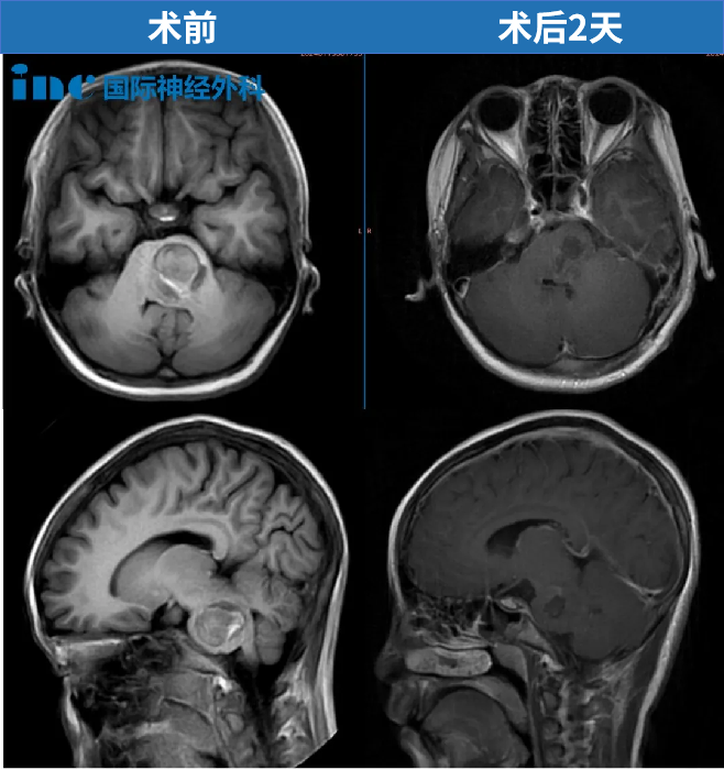 11歲，貝貝，腦干海綿狀血管瘤出血，120急救送進ICU、病情危急，2024年巴教授為其成功示范手術(shù)，目前已回歸校園。