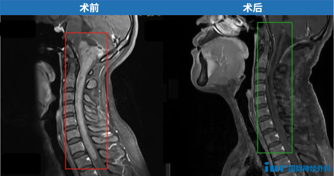 33歲，鄭女士，15cm腫瘤起源于腦干下部，累及延髓和顱頸交界區(qū)，且向下方延伸到整個頸部脊髓以及一直到第一胸椎水平，巴教授成功示范手術(shù)。
