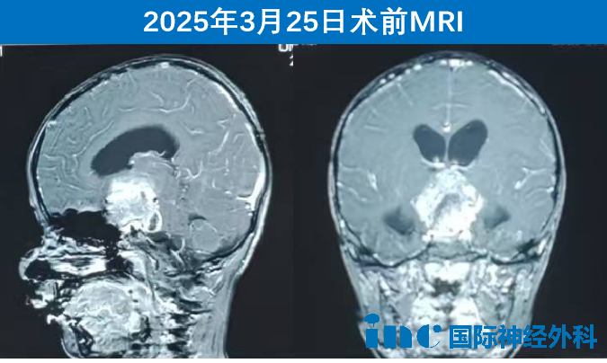 在蘇州大學(xué)附屬兒童醫(yī)院，“神奇”的巴爺爺又為一名年僅5歲的視路膠質(zhì)瘤患兒守護光明，讓幼小的生命得以繼續(xù)探索這絢爛春光！