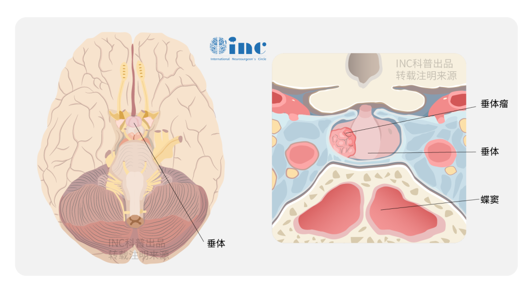 INC國際大咖一次手術(shù)全切侵襲性垂體瘤