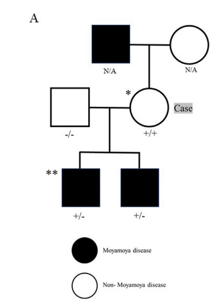 而在查看了她的家族史后，發(fā)現(xiàn)她的2個孩子和叔叔有典型的煙霧病和RNF213 p.R4810K雜合子變異，3人均進行了血運重建術(shù)。