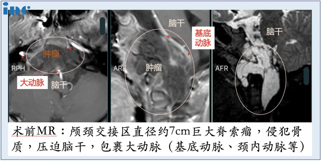 林林的術(shù)前MRI影像