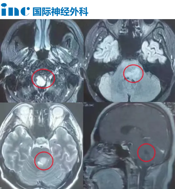 腫瘤呈彌漫性生長(zhǎng)，穿刺活檢還是開(kāi)顱活檢?