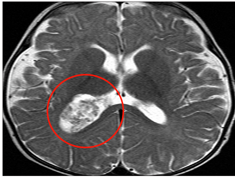 在SickKids，磁共振成像(MRI)顯示，Oliver右側(cè)腦室后角有一個(gè)大腫塊，考慮脈絡(luò)叢乳頭狀瘤病變，并有蒂連接，伴有中度腦積水。