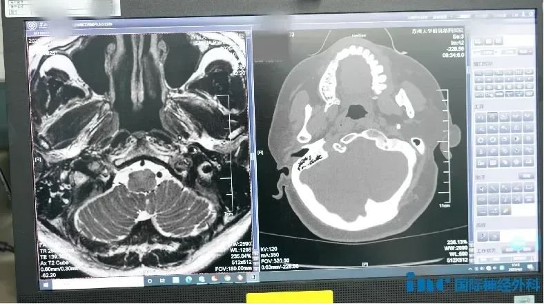 頸靜脈孔區(qū)的腫瘤