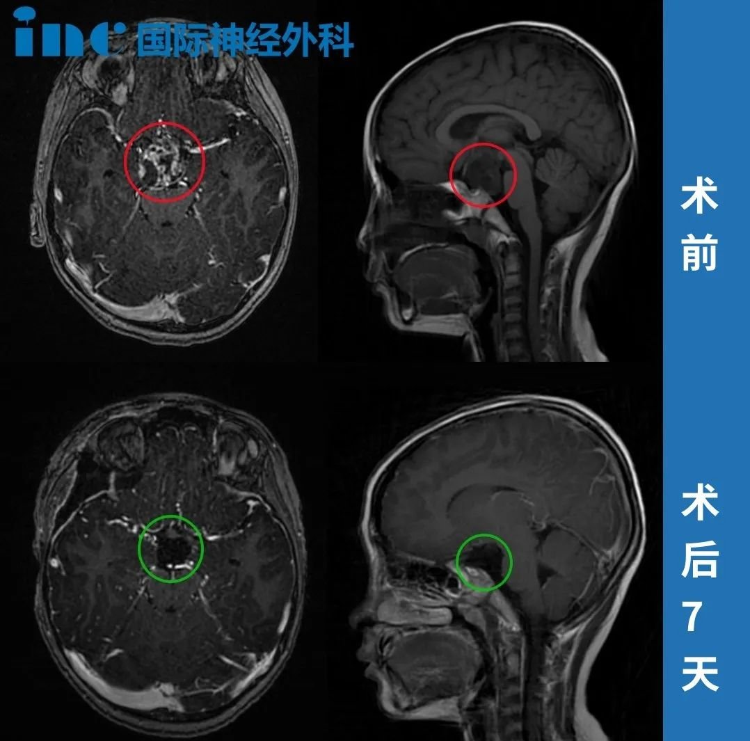目前小迪情況穩(wěn)定，后續(xù)需定期隨訪。