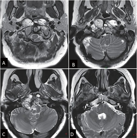 Lariboisiere 大學(xué)醫(yī)院的核磁共振成像（MRI）檢查顯示，腫瘤位于下斜坡，并向周邊廣泛延伸，右側(cè)C1和C2、巖尖水平均見(jiàn)有腫瘤，右側(cè)椎動(dòng)脈被腫瘤包繞，腦干受壓迫（?圖1）。CT掃描也顯示骨質(zhì)廣泛的腫瘤浸潤(rùn)。