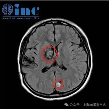 在做過核磁檢查之后，發(fā)現(xiàn)原本在右側(cè)基底節(jié)的病灶變大了，并且出現(xiàn)了新的出血在左頂葉枕區(qū)。