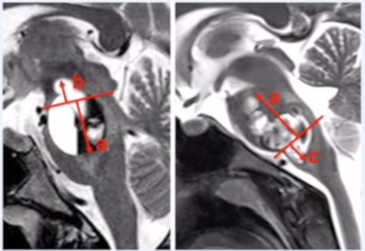 跨區(qū)域腦干海綿狀血管瘤MRI