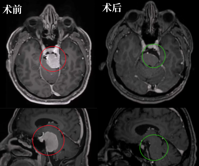 術(shù)前術(shù)后MRI影像