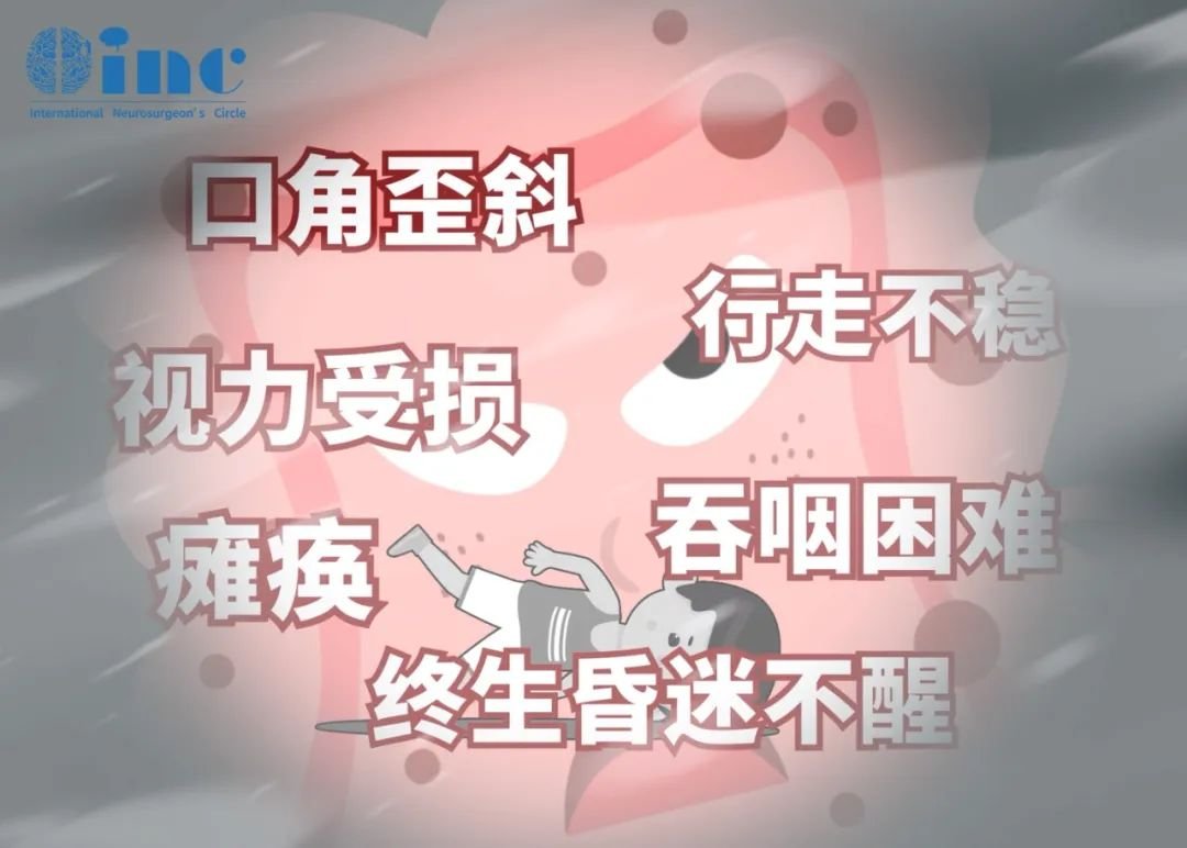 腫瘤全切非常困難，術(shù)后容易復(fù)發(fā)