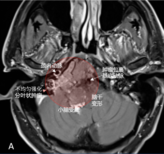 術(shù)前MRI顯示一個(gè)軸內(nèi)-軸外的腫瘤，累及斜坡和顱頸交界處，壓迫腦干致腦干移位，為不均勻增強(qiáng)。
