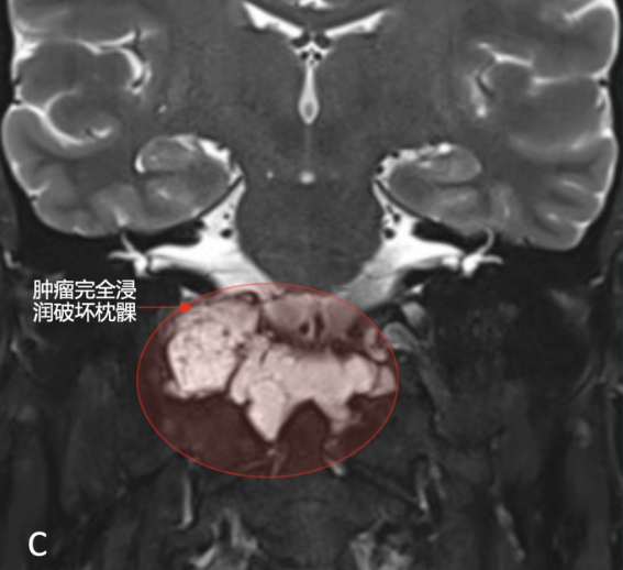 右側(cè)枕髁被腫瘤完全破壞