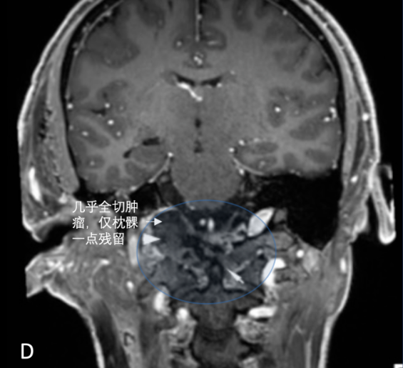 術(shù)后MRI證實(shí)Nick的腫瘤幾乎被完全切除，僅左側(cè)枕髁水平有一個(gè)小腫瘤殘余。術(shù)后過(guò)程平穩(wěn)。