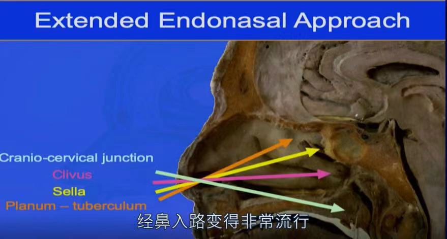 EEA相對(duì)于Kawase入路的主要優(yōu)勢(shì)在于，EEA避免了大腦回縮，這是現(xiàn)代顱底外科的基本原則。此外，還可以擴(kuò)大手術(shù)視野以及直接進(jìn)入腫瘤的血管供應(yīng)。在這個(gè)區(qū)域應(yīng)用EEA時(shí)，可以避免硬膜間腔，特別是卵圓孔周?chē)撵o脈出血。