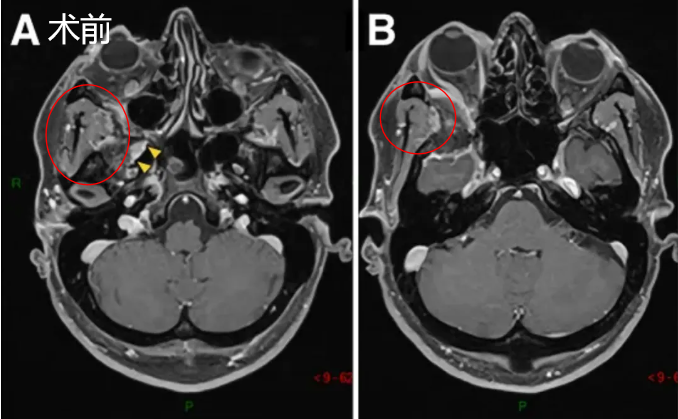 41歲男性蝶眶腦膜瘤侵襲翼腭窩，成功全切