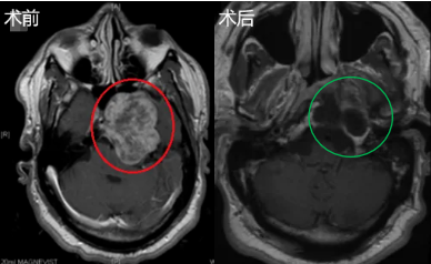 51歲男性軟骨瘤侵襲海綿竇，成功全切