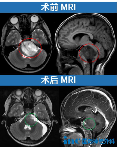 7歲男孩一顆巨大腦瘤貫穿腦干：從走路跌倒到3公里“小飛魚”的逆襲