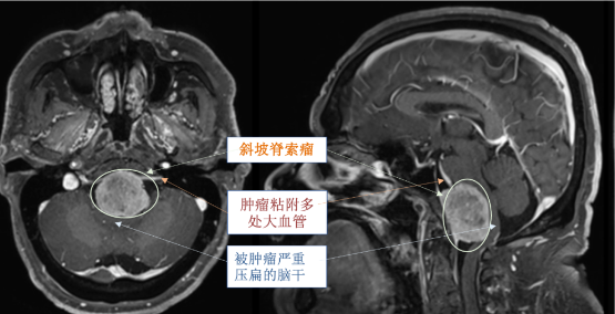 當(dāng)腦干被巨大腫瘤壓成＂紙片＂：一位斜坡脊索瘤患者的自救之路！