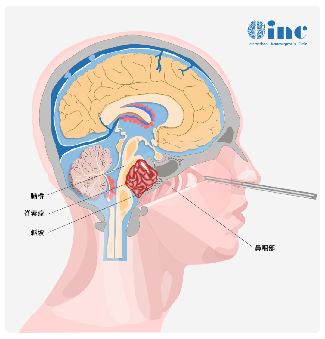 福教授耐心向我解釋了我的腫瘤為什么很難全切：